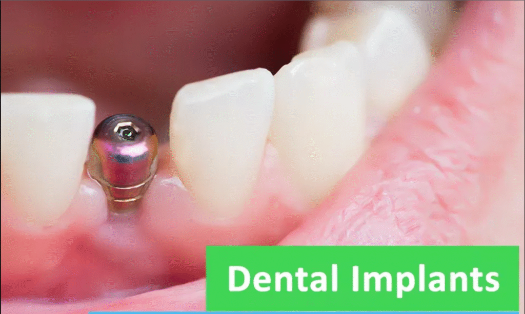 Transform Your Smile with the Best Dental Implants in Pune