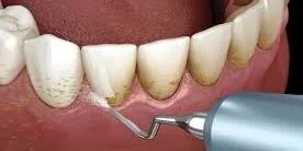 Comprehensive Gum Care – The Best Dentist in Viman Nagar