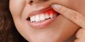 Comprehensive Gum Care: The Best Dentist in Koregaon Park