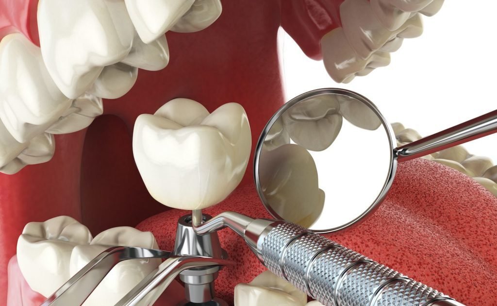 Preparing for Dental Implant Surgery: What You Need to Know