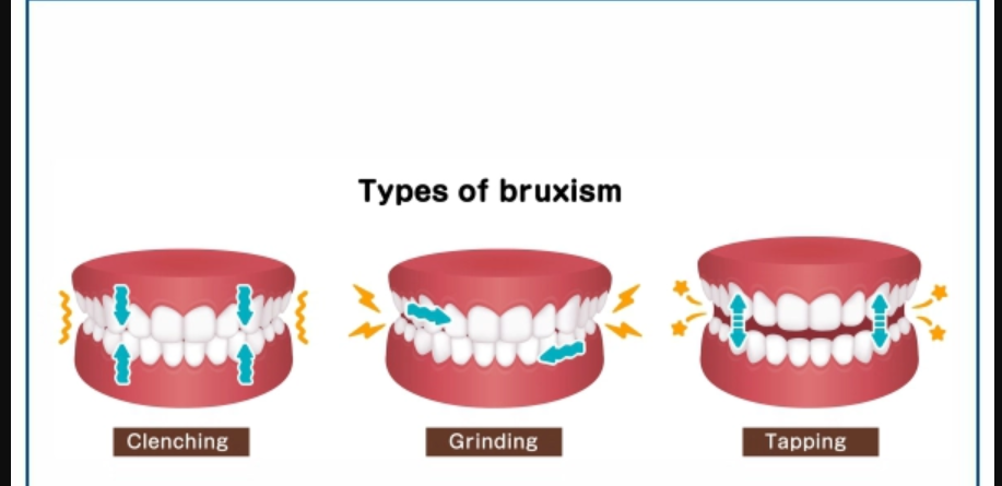 Unveiling the Grind: Understanding Teeth Clenching and Effective Treatments in Pune with Braces & Smiles
