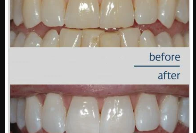 Sparkling Smiles: Your Guide to Teeth Whitening in Pune