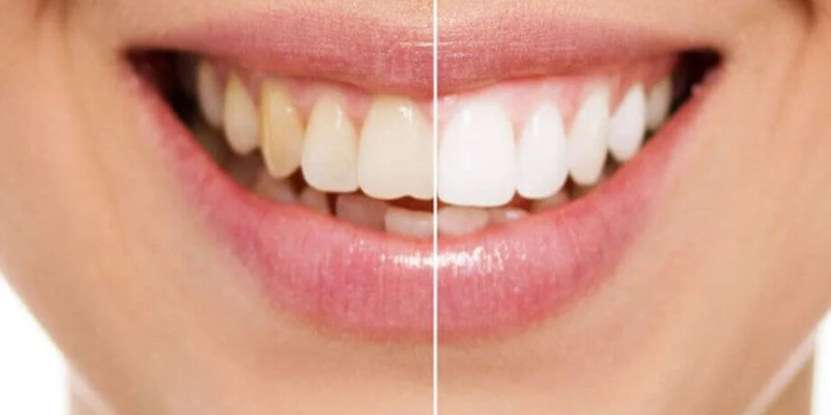 Most Effective Teeth Whitening Treatments in Pune