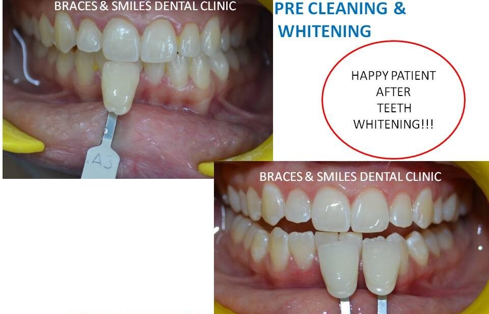 All You Need To Know About Teeth Whitening- Teeth Whitening in Koregaon Park