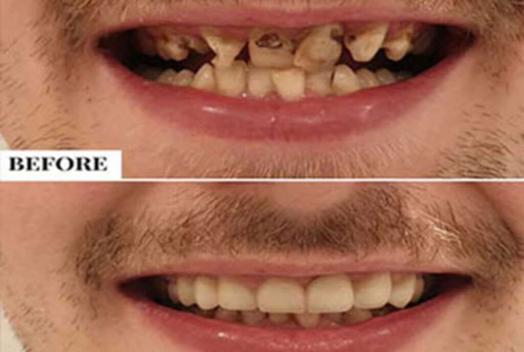 Braces for kids – What’s the right age?