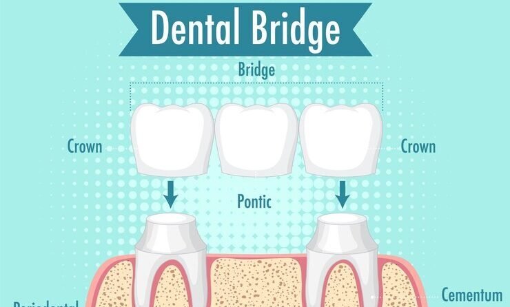 Crowns and Bridges: Reinventing Your Smile, One Tooth at a Time