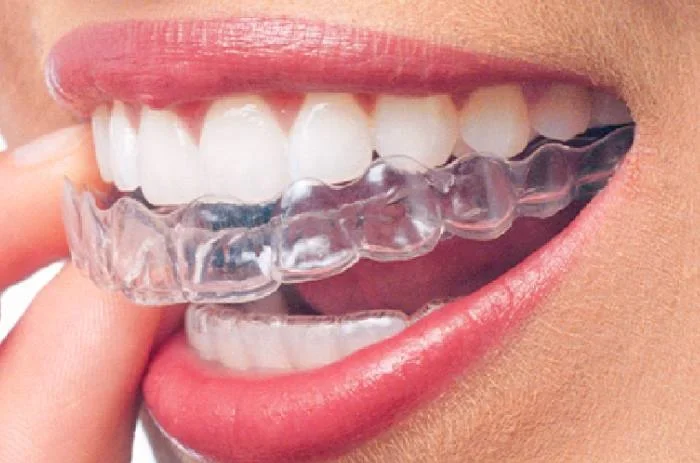 What Is Invisalign Orthodontics | Orthodontics in Pune