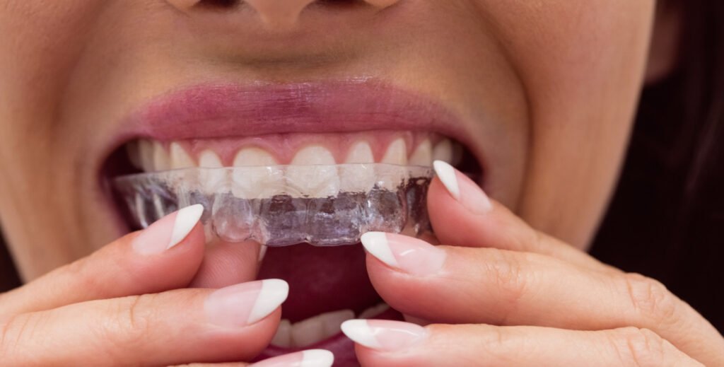 How to Find the Best Invisalign in Viman Nagar?