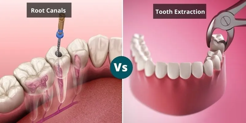 Root Canal Treatment vs. Tooth Extraction: Which is the Better Option?