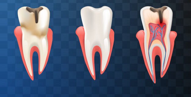 Aftercare Matters: Guide for a Smooth Recovery from Root Canal Treatment in Pune