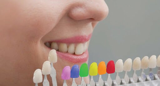 Maintain tooth-colored fillings with these essential tips You