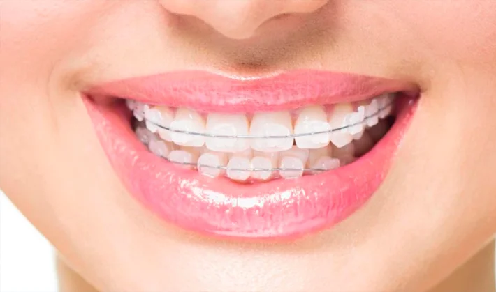 Straighten Your Smile With Dental Braces in Pune