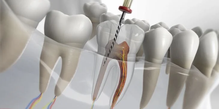 What Happens After a Painless Root Canal Treatment? You