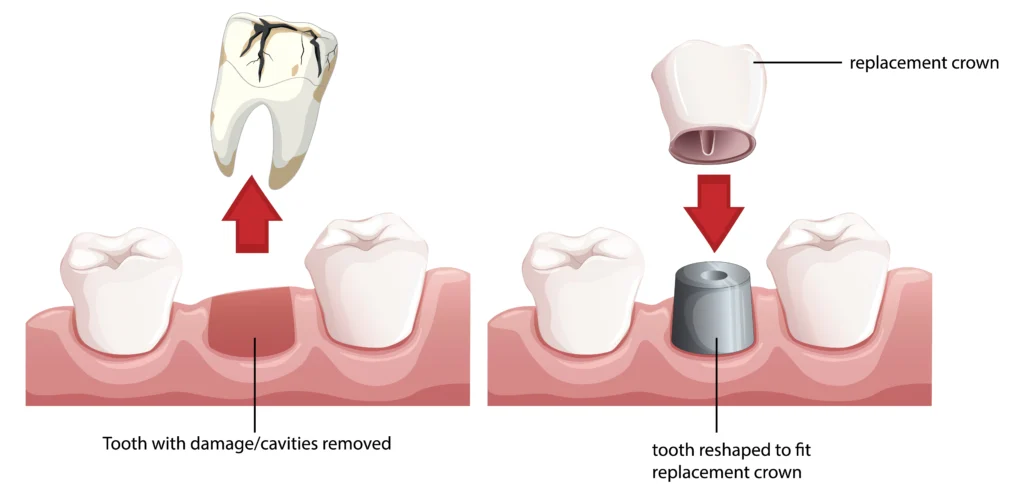 Find Dental Crown And Bridges in Pune Viman Nagar
