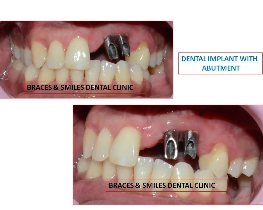 Find Dental Implants in Pune